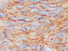 Immunohistochemistry for b-catenin in GIST, which is negative as there is only staining of cytoplasm but not of cell nuclei. Negative nuclear b-catenin staining is seen in approximately 95% of GIST cases, and helps in distinguishing such tumors from b-catenin positive spindle cell tumors. Beta-catenin immunohistochemistry in gastrointestinal stromal tumor (GIST).jpg