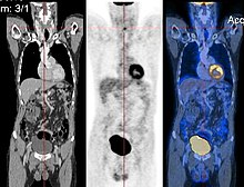 CT image (left), PET image (center) and overlay of both (right) after correct registration. CT-PET.jpg