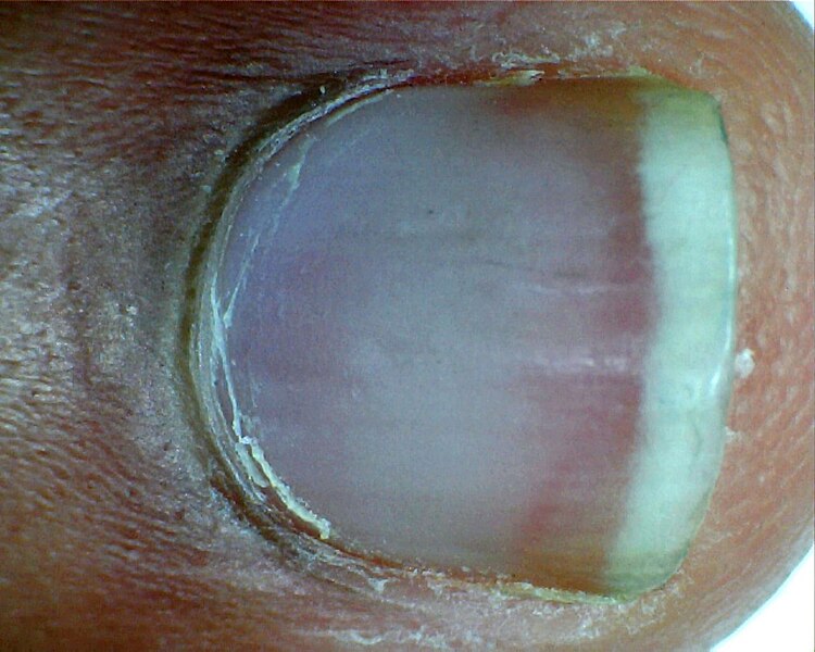 File:Caucasian nail.jpg