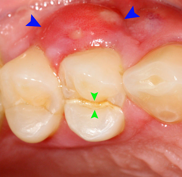 6 Things Which You Should Know About Gum Disease And Gingivitis