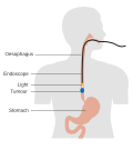 Thumbnail for File:Diagram showing photodynamic therapy for oesophageal cancer CRUK 494.svg