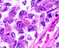 Endometrial endometrioid adenocarcinoma, nuclear and architectural grade 3.jpg