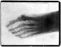 Radiograph of a pantomime artist's foot, revealing a needle by one of the toes, c. 1895