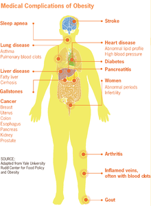 Obesity can effect the entire physical health of an individual in the long term. Medical complications of obesity.png