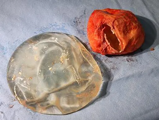 File:Removed Breast Implant & Capsular Contracture Tissue.webp