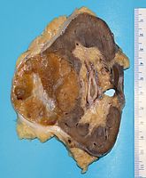 Oncocytoma