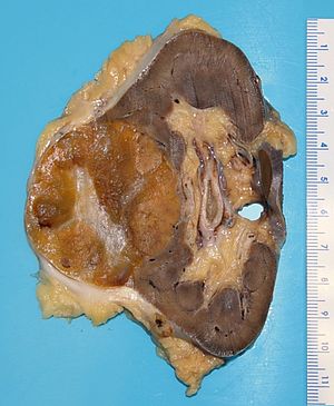 Gross examination of a kidney (right of image) with a renal oncocytoma (left of image). Renal oncocytoma.jpg