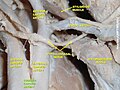 Artera carotidă comună