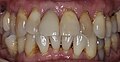 Zahn 11 (mit Krone) vor Extraktion aufgrund einer Wurzelfraktur und Sofortimplantation.