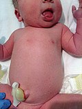 Thumbnail for Transient neonatal pustular melanosis