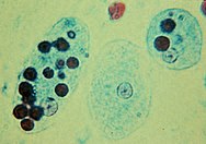 Trophozoites of Entamoeba histolytica with ingested erythrocytes Trophozoites of Entamoeba histolytica with ingested erythrocytes.JPG
