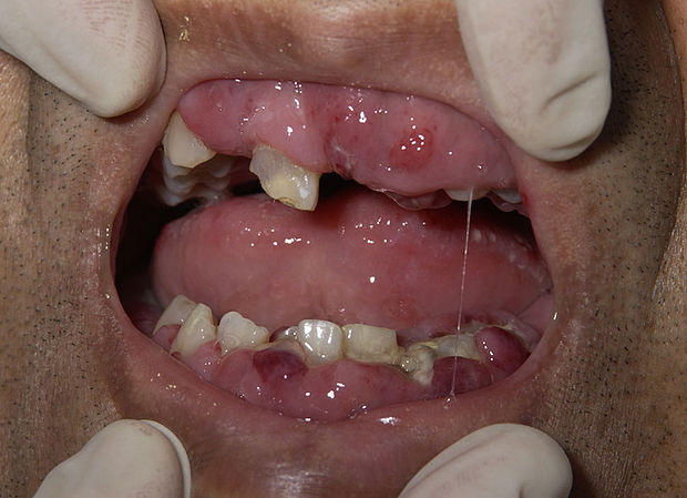 Swollen gums due to infiltration by leukaemia cells in a person with AML