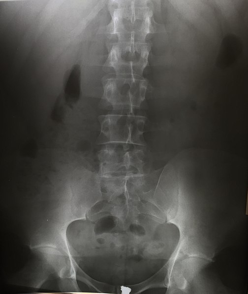 File:AP lumbar xray.jpg