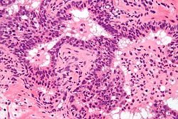 Micrograph showing a neutrophilic infiltration of prostatic glands - the histologic correlate of acute prostatitis.