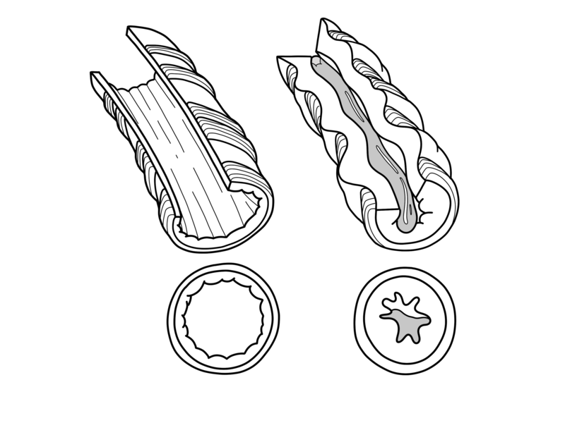 File:Asthma-bronchial-tube-cross-section.png