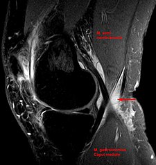 Baker's cyst on MRI, sagittal image