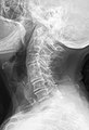 Block vertebrae of the cervical spine (vertebrae 4 and 5). Probably based on degenerative or inflammatory changes.