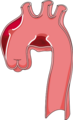 Aortic aneurysm 6