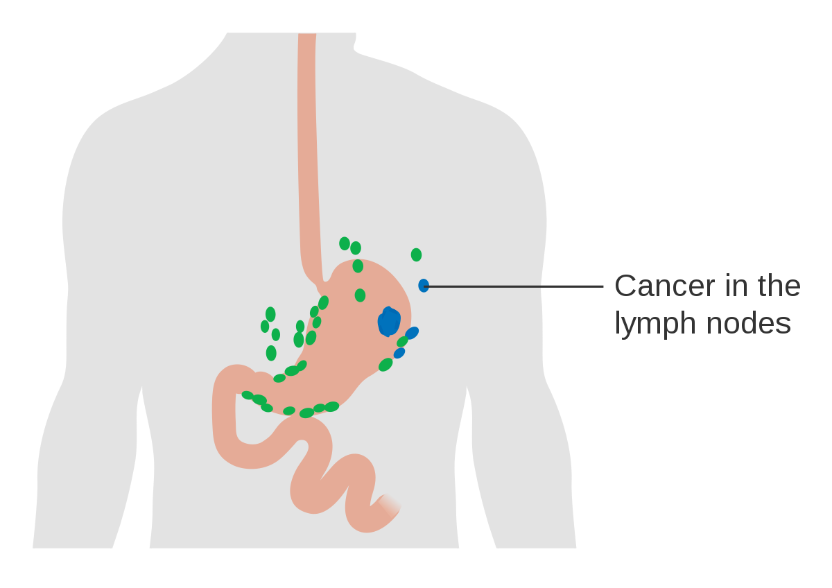 Aggressive cancer in lymph nodes
