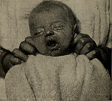 "Hereditary" syphilis: radiating fissures of the lips (1916). Diseases of children (1916) (14597432110).jpg