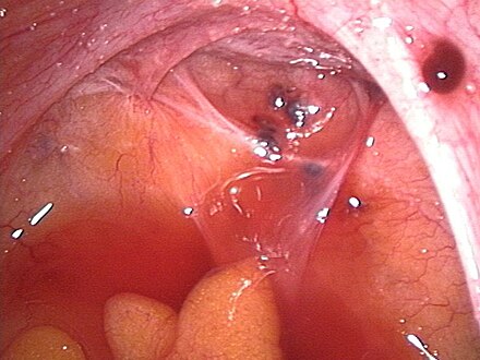 Laparoscopic image of endometriotic lesions in the Pouch of Douglas and on the right sacrouterine ligament