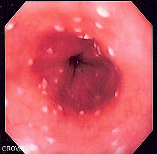 <span class="mw-page-title-main">Esophageal candidiasis</span> Medical condition