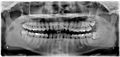 Дистоугольно ретинированы верхний левый (изображение справа) и верхний правый (изображение слева) зубы мудрости. Левый нижний зуб мудрости ретинирован горизонтально. Нижний правый зуб мудрости вертикально ретинирован.