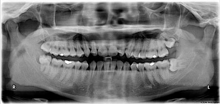 ไฟล์:Impacted_wisdom_teeth.jpg
