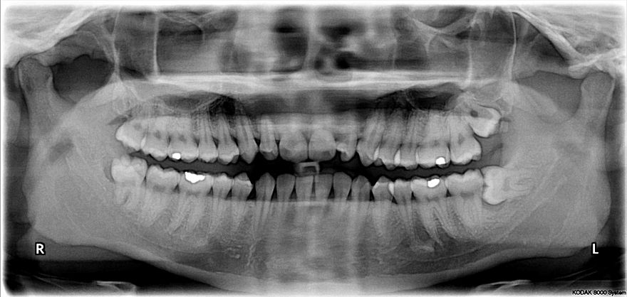 X-ray of the teeth and jaw showing the normal permanent teeth. The last two teeth on the patient's left (the dentist's right), 28 and 38 - the maxillary and mandibular third molars (popularly the upper and lower wisdom teeth) are severely impacted.