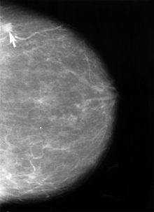 Una immagine ottenuta dall'indagine mammografica (mammogramma). La freccia indica una piccola lesione cancerosa.