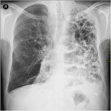 A severe case of bullous emphysema