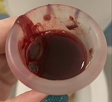 Vaginal bleeding - Wikipedia