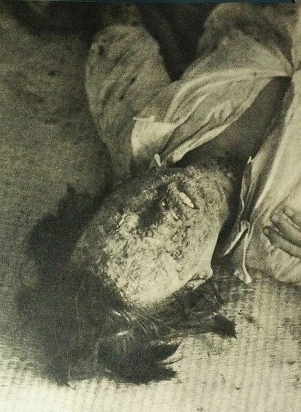 File:Mobilized school girl suffered burns to face, Hiroshima Red Cross Hospital.jpg