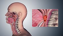 3D medical illustration showing the cancer formation in the tissues of the oropharynx