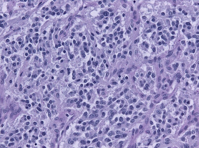 File:Paraganglioma PAS.jpg