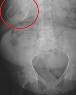 <span class="mw-page-title-main">Porcelain gallbladder</span> Medical condition