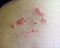 Shingles rash, thigh. Caused by the herpes zoster virus.jpg