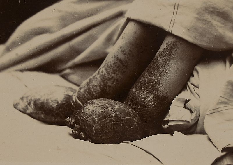 File:'Elephantiasis' of the legs of a woman Wellcome L0062010.jpg