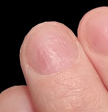 Заметные продольные и поперечные борозды и гребешки, а также ямки на поверхности ногтя являются следствием изменения матрикса.