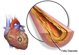 Микрофотография коронарной артерии с наиболее распространённой формой коронарной недостаточности (атеросклероз).