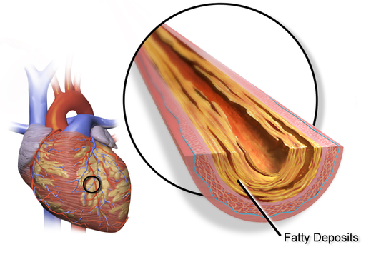 Blausen 0257 CoronaryArtery Plaque