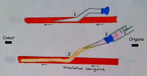 Diagram over venøs kanylering