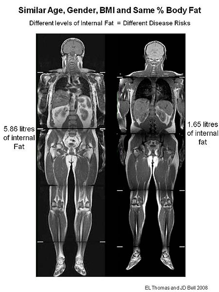 File:Coronal Image of a TOFI and a Normal Control.jpg