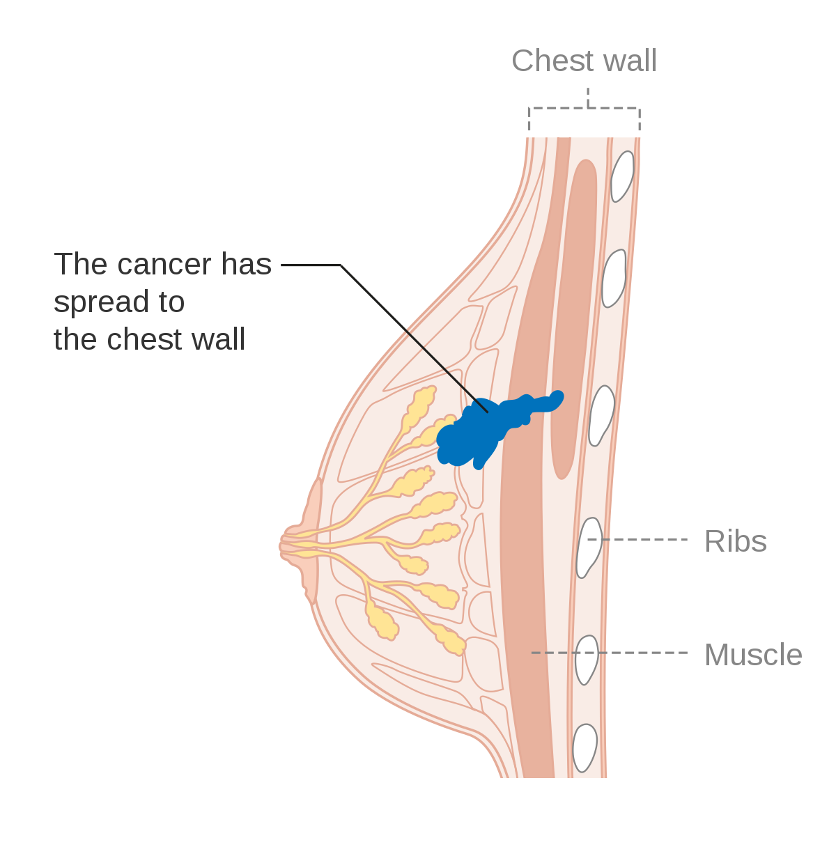 File:Diagram 1 of 2 showing stage 3B breast cancer CRUK 004.svg - Wikipedia