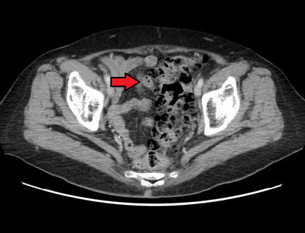 Diverticular disease