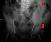 A fracture of the left iliac wing IliacCrestFrac.png