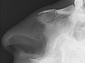 Medical X-Ray imaging NJR06 Nevit nasal bone fracture.jpg