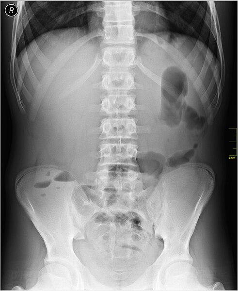 File:Medical X-Ray imaging QSP06 nevit.jpg