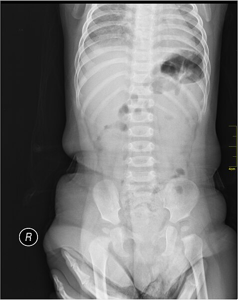 File:Medical X-Ray imaging WHB07 nevit.jpg