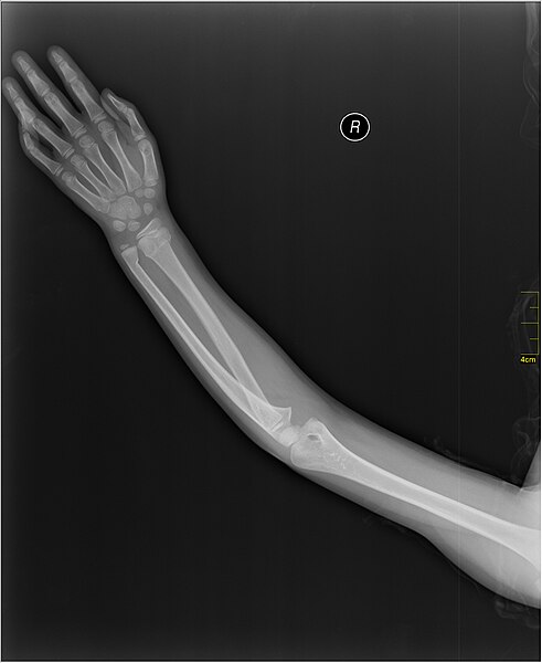 File:Medical X-Ray imaging WXW07 nevit.jpg